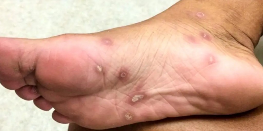 Preocupación sanitaria: Jóvenes concentran el 50% de los casos de sífilis en la provincia de&nbsp;Salta